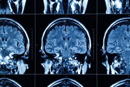 MRI scan human head Tomography
