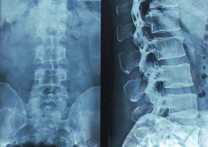 Xray of a Human Spine