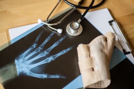 Orthopedic doctor examining a hand x-ray on a wooden desk, with a stethoscope and an orthopedic brace resting on the radiography, suggesting a diagnosis of a traumatology case stock photo