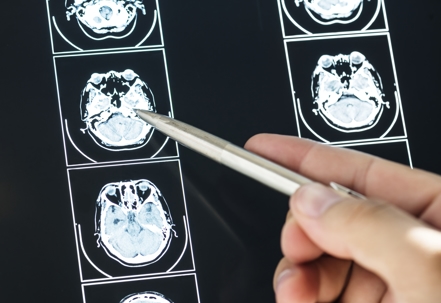 Photo of Brain CT Scan Pittman Law Firm